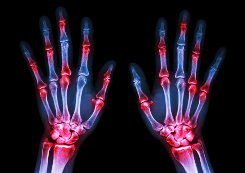 Rheumatoid arthritis is characterized by painful inflammation and progressive immobility of the joints.