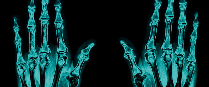 Research reveals genetic basis of rheumatoid arthritis in Arabs
