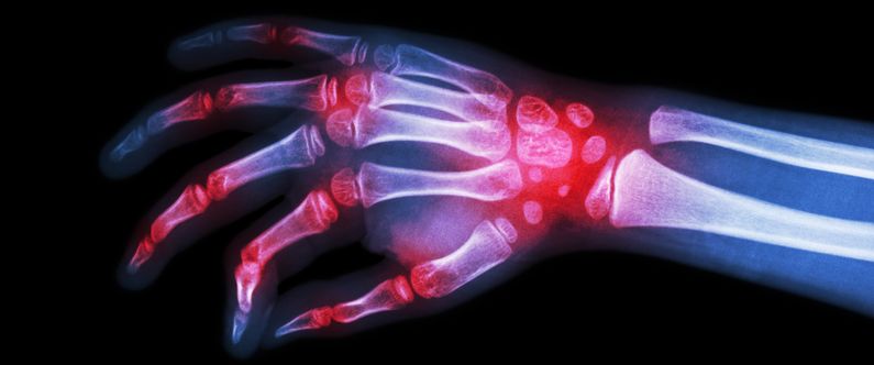 WCM-Q helps set arthritis guidelines